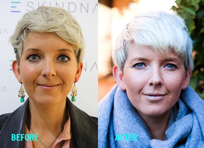 SKIN-DNA BEFORE AND AFTER-2-images - Londoner In Sydney