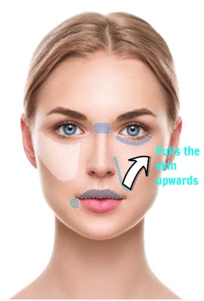 cheek-fillers-skin-dna-sydney - Londoner In Sydney