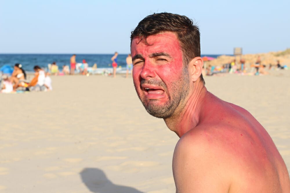 british-burnt-in-australia - Londoner In Sydney british-burnt-in-australia
